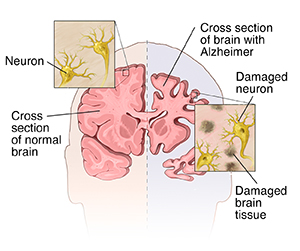 Front view cross section of brain comparing normal on one side and Alzheimer on the other, including insets of normal neurons and Alzheimer neurons.